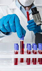 ALFA-1-GLICOPROTEÍNA ÁCIDA 
