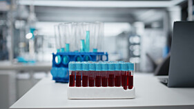 HEPATITE A  (IgM) 