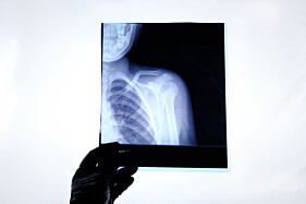 RADIOGRAFIA ARTICULAÇÃO ESCAPULOUMERAL (OMBRO)