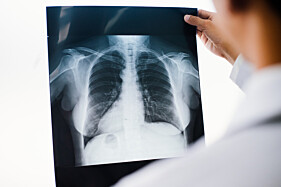 RADIOGRAFIA COSTELAS - POR HEMITÓRAX