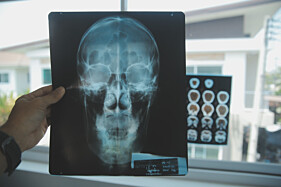 RADIOGRAFIA SELA TÚRCICA