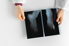 RADIOGRAFIA ARTICULAÇÃO TIBIOTÁRSICA (TORNOZELO)