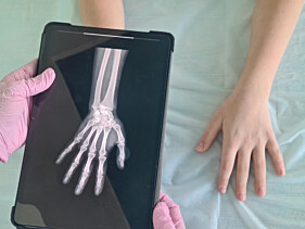 TOMOGRAFIA SEGMENTOS APENDICULARES (BRAÇO OU ANTEBRAÇO OU MÃO OU COXA OU PERNA OU PÉ)